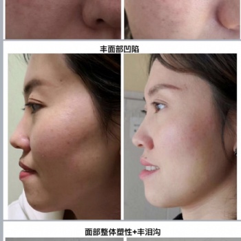 尋夢緣美業(yè) 中醫(yī)美容 一根針微整 技術培訓